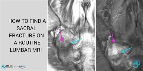 How to find a Sacral Fracture on a Lumbar MRI - Radedasia