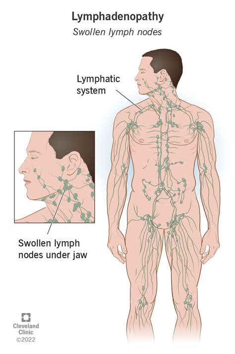 Swollen Lymph Nodes (Lymphadenopathy/Adenopathy): Symptoms & Causes ...