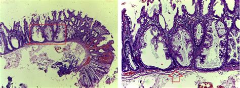 GASTROINTESTINAL AND LIVER HISTOLOGY PATHOLOGY ATLAS: SESSILE SERRATED POLYP (AKA SESSILE ...