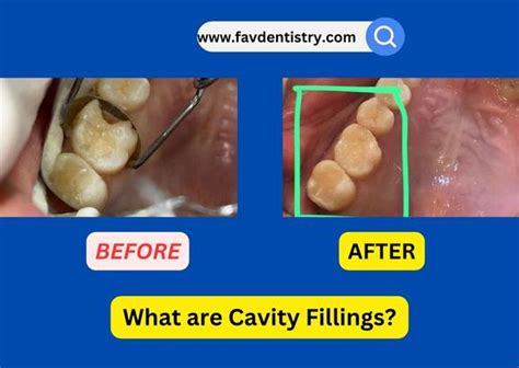 What are Cavity Fillings? - favourite dentistry