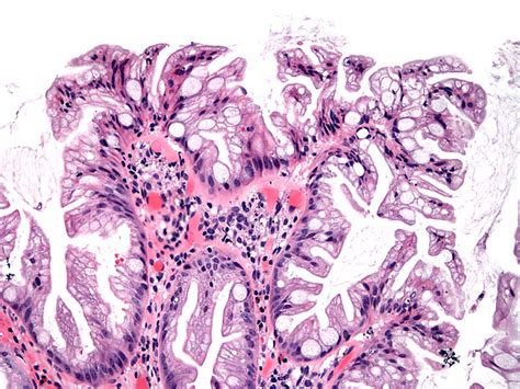 Sessile Polyp Histology