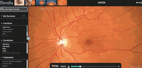 A Treatment for an ‘Untreatable’ Blinding Condition | Rendia