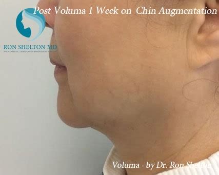 Voluma Fillers NYC | Anti Aging Treatments NYC by Dr Ron Shelton