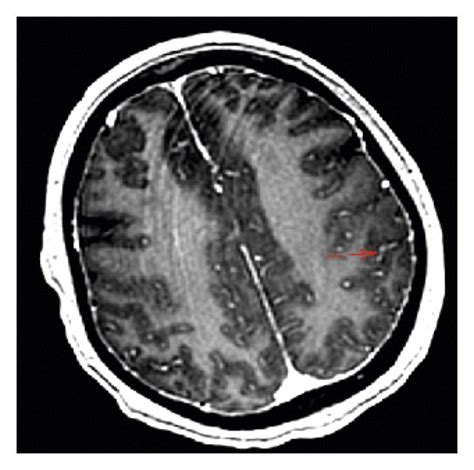 MRI brain with IV contrast suggesting sulcal enhancement of the gyrus ...