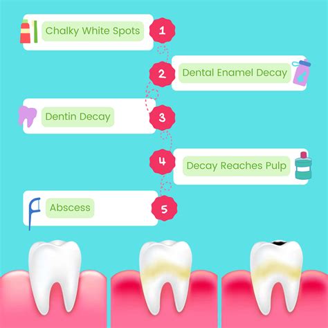 Tooth Decay Stages