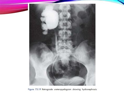 Hydronephrosis and Pyonephrosis