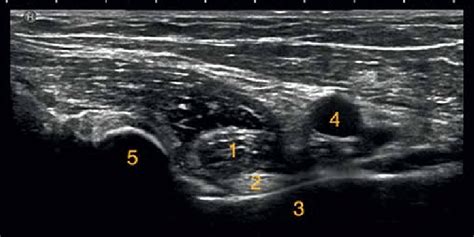 Anterior Hip Joint Ultrasound