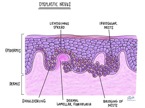 Dysplastic Nevus Histology