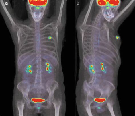 Pet Ct Scan For Kidney Cancer - CancerWalls