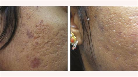 Bacne Scars Treatment