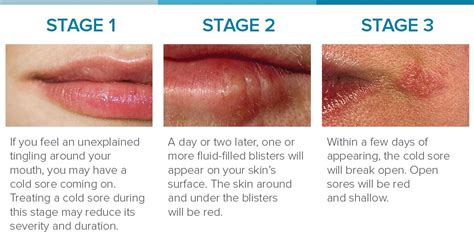 Cold Sore Stages: Identification and Treatment