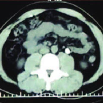 a and 1b: CT scanning showing RT Pyonephrosis with multiple stones and ...