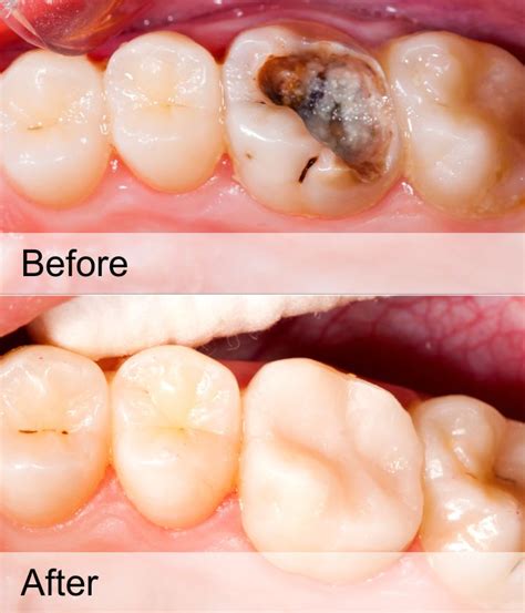 TOOTH CAVITY FILLING TREATMENT - MATRIX DENTAL AND SKIN LOUNGE