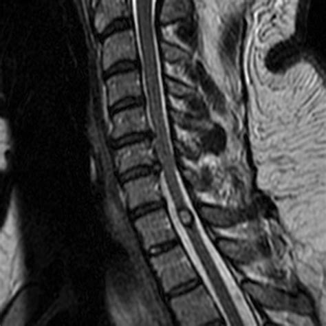 Spinal Cord Cavernous Malformation | Radsource