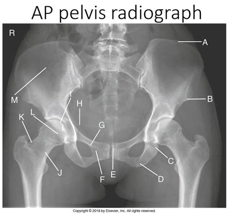 AP Pelvis Radiograph - Diagram Diagram | Quizlet