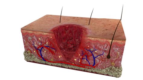 Stages Of Soft Tissue Healing • Bodybuilding Wizard