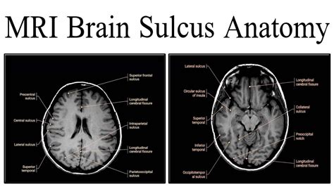 Intraparietal Sulcus Mri