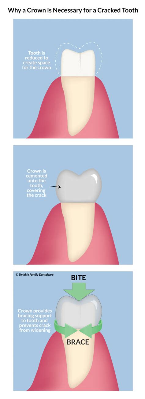 Is a Cracked Tooth Treatable? - Root Canal Treatment - Crown - Twinkle Family Dentalcare