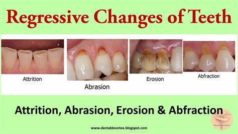 Tooth Abrasion Vs Erosion