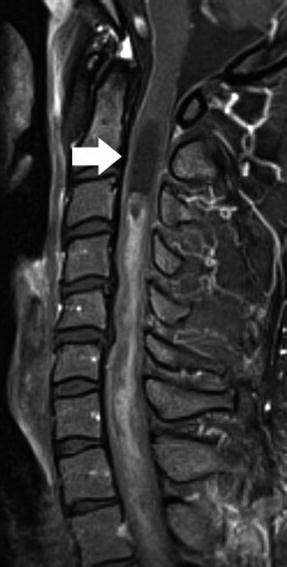 Spinal Cord Tumors: Anatomic and Advanced Imaging | Radiology Key