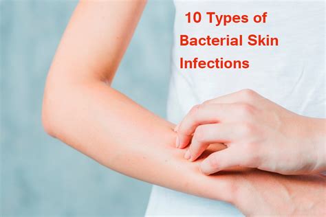 10 Types of Bacterial Skin Infections - Yabibo