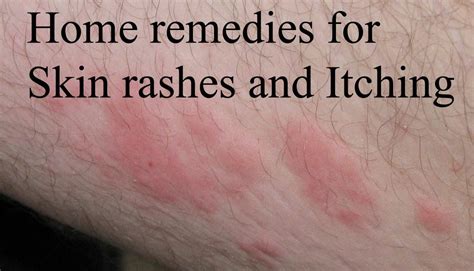 Best Home remedies for Skin rashes and Itching | Online bee | Home ...