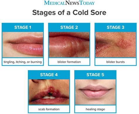 Herpes Vs Cold Sore