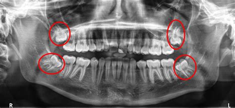 Wisdom Teeth McMurray PA | Third Molars | Impacted Tooth