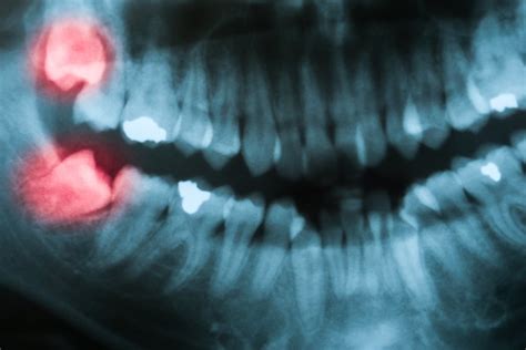 Symptoms Of Impacted Wisdom Tooth | Shinagawa Orthodontics