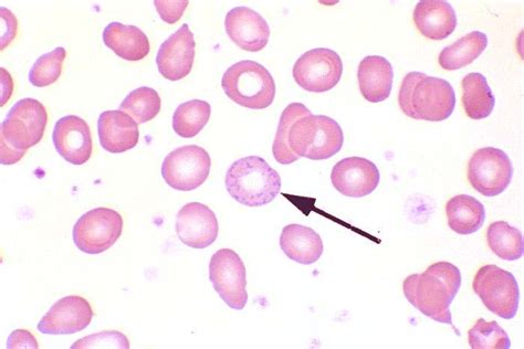 Lead Poisoning - Hematology - Medbullets Step 1