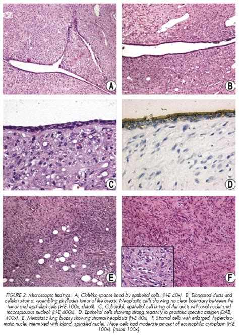 Neoplasm: Tumor Vs Neoplasm