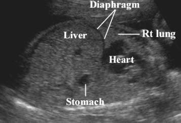 Fetal Liver and Diaphragm