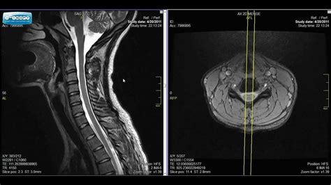 Normal Spine Mri | www.pixshark.com - Images Galleries With A Bite!