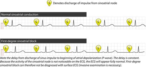 Sinoatrial block (SA block): ECG criteria, causes and clinical features ...