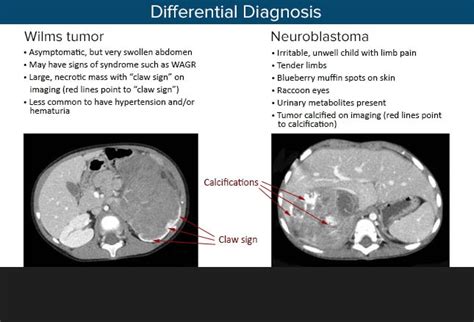 Wilms Tumor: A Pediatric Oncology Success Story