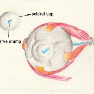 Incised scleral shell after evisceration. | Download Scientific Diagram