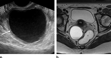 Rectal duplication cyst in a 43-year-old woman who presented with... | Download Scientific Diagram