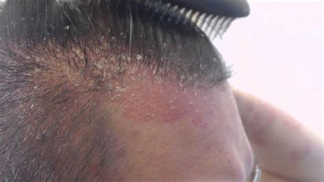 scalp psoriasis hair loss - pictures, photos