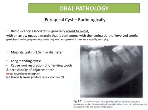 Radicular cyst or Periapical cyst