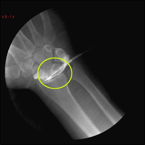 Ulnar Collateral Ligament Wrist Mri