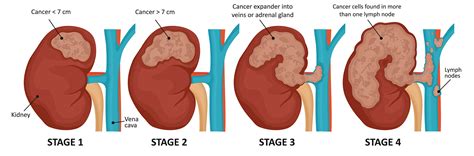 Kidney Cancer signs and symptoms | Austin Texas