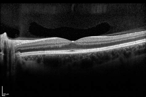 Retinal Inner Layers Segmentation on OCT Images by RSIP Vision