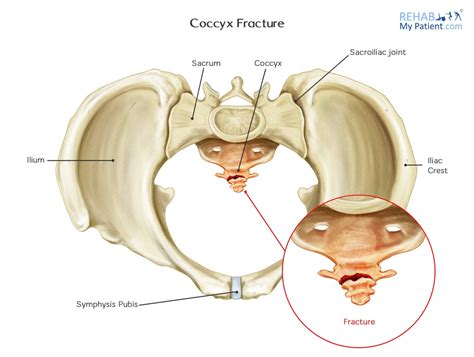 Coccyx Fracture | Rehab My Patient