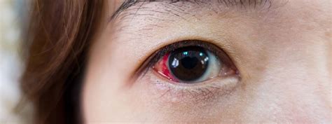 Common Eye Injuries - Dr. Barry Leonard and Associates