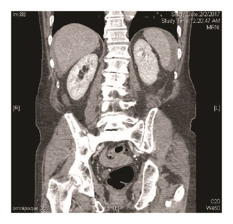 Coronal CT scan demonstrating hemoperitoneum from iatrogenic spleen injury. | Download ...