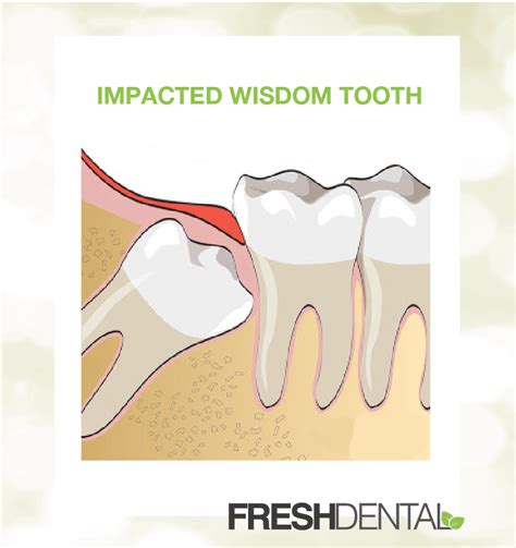 Wisdom Teeth Removal Charlotte NC - Fresh Dental NC