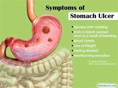 Complications of stomach Ulcer, Foods To Avoid ~ Grace Ngo Foundation