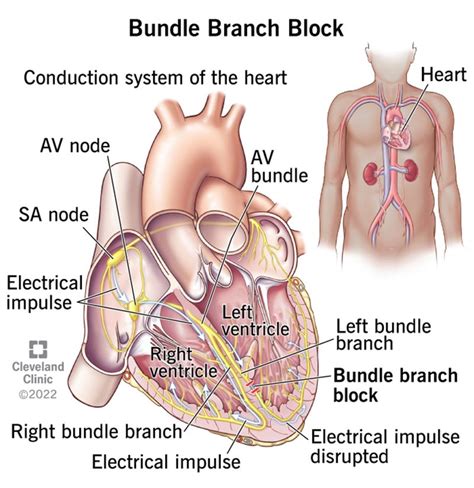 Bundle Branch Block: Causes, Symptoms & Treatment