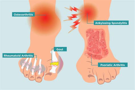 Arthritis in Your Feet: Causes, Symptoms, and Treatment