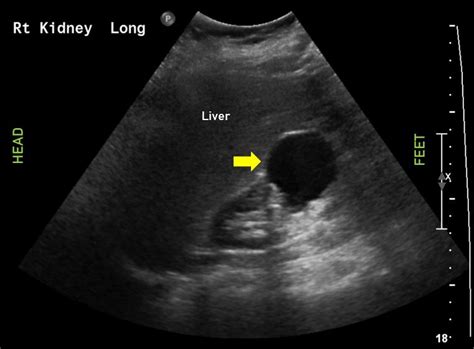 Kidney Cyst Ultrasound And Biopsy Procedure